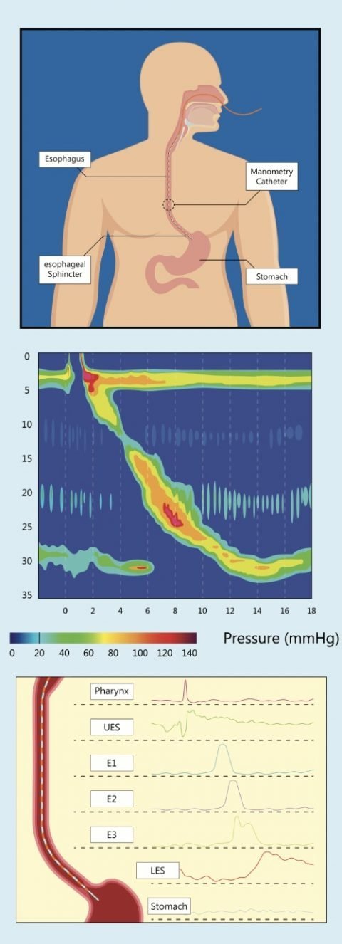 Oesophageal Manometry / PH Testing - Gastro IQ